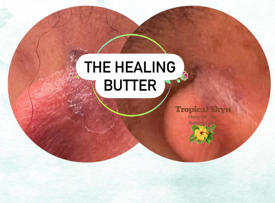 Healing butter for eczema